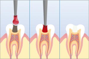 歯科用う蝕除去液ソルブを使った治療