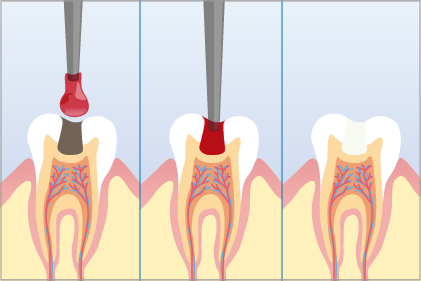 歯科用う蝕除去液を使った治療