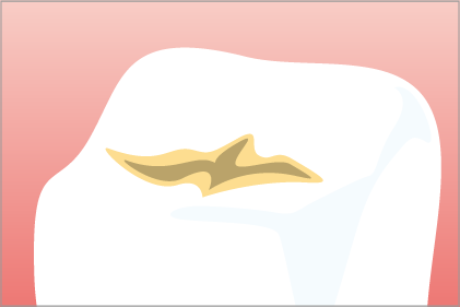 シーラントを使った治療と予防