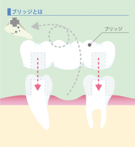 ブリッジ治療