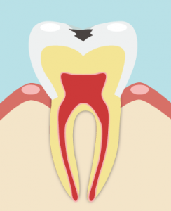 進行した虫歯
