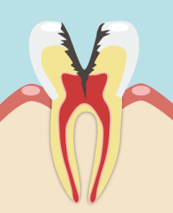重度の虫歯