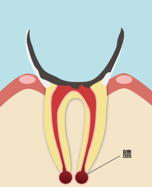 ひどい虫歯の状態 ひどい虫歯の状態