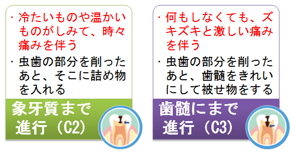 虫歯の進行