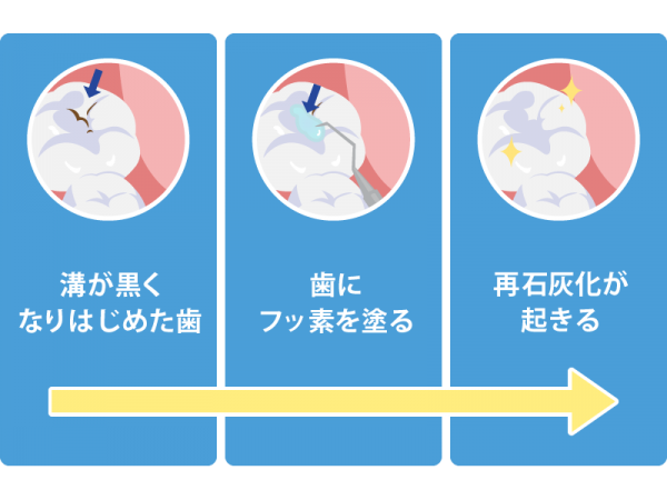 C0 フッ素による再石灰化 C0 フッ素による再石灰化