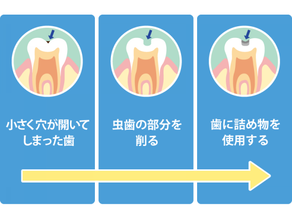 C1 初期の虫歯レベルの治療法 C1 初期の虫歯レベルの治療法