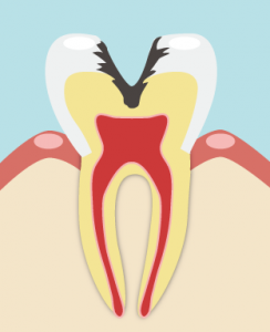 進行度の高い虫歯