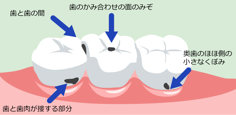 虫歯のできやすい場所