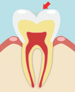 初期の虫歯