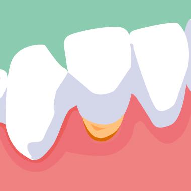 知覚過敏の対処法