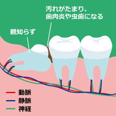 親知らず