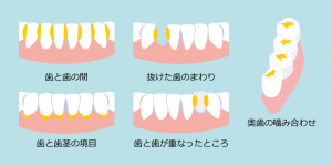 歯垢が溜まりやすい場所