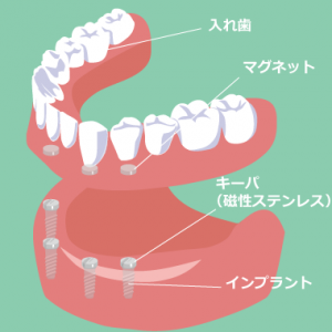 インプラント義歯