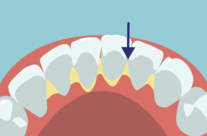 歯石が付きやすい下顎の前歯の裏側