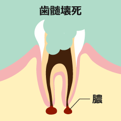 神経が死んでいて、痛みを感じていない