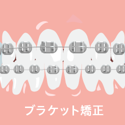 矯正方法_ブラケット