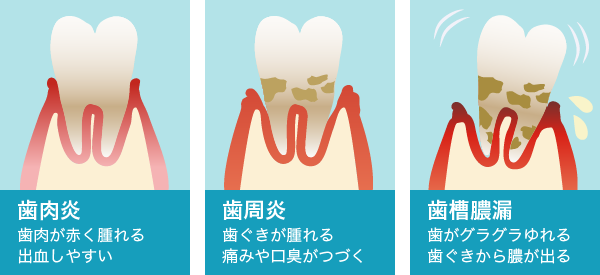 歯周病の症状 歯周病の症状