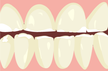 ダイレクトボンディング法