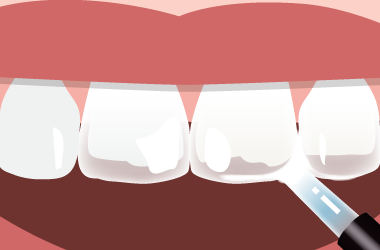 歯が透ける症状