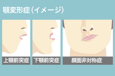 顎変形症
