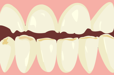 中期以降の酸蝕歯