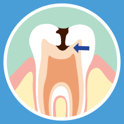 虫歯の進行状況