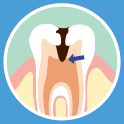 虫歯の画像④
