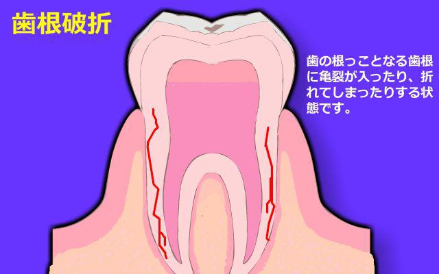 歯が欠ける・原因2 歯が欠ける・原因2