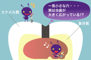 中の虫歯 中の虫歯