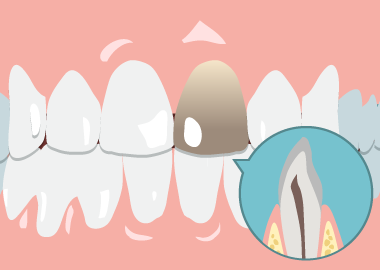 歯の神経が死んでいる 歯の神経が死んでいる
