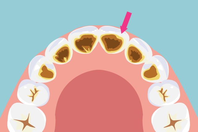 歯の裏側にヤニが付着している 歯の裏側にヤニが付着している