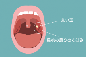 臭い玉のできる場所②