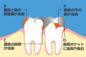 銀歯を入れた後の虫歯