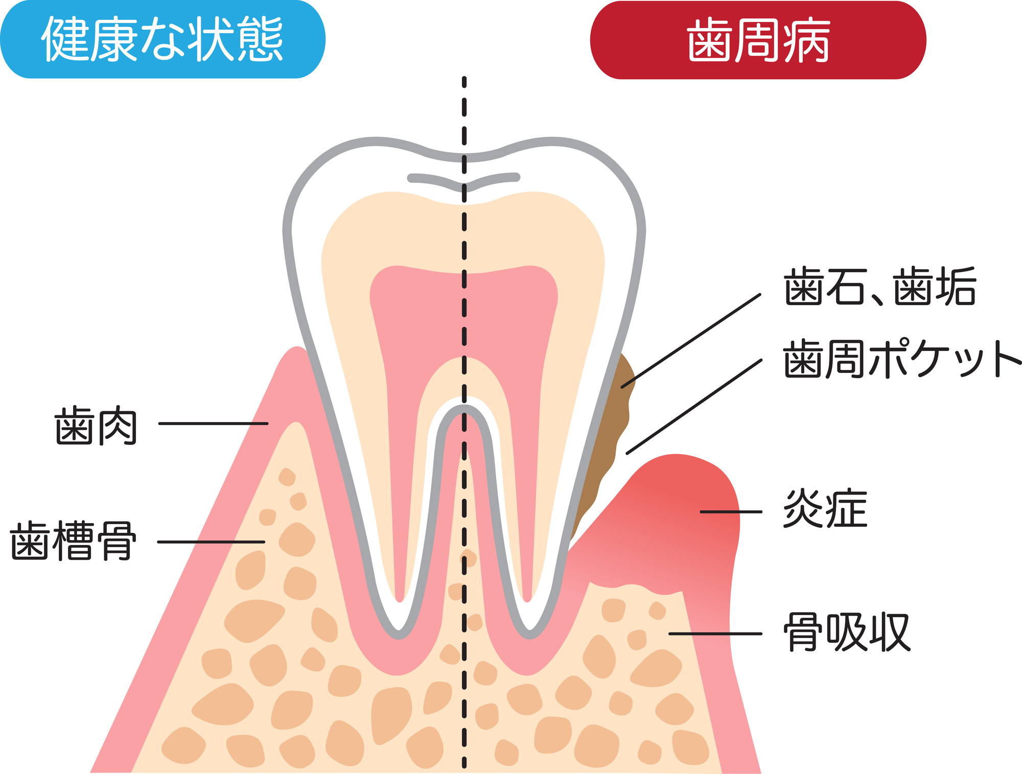 健康な歯茎と歯周病のイラスト