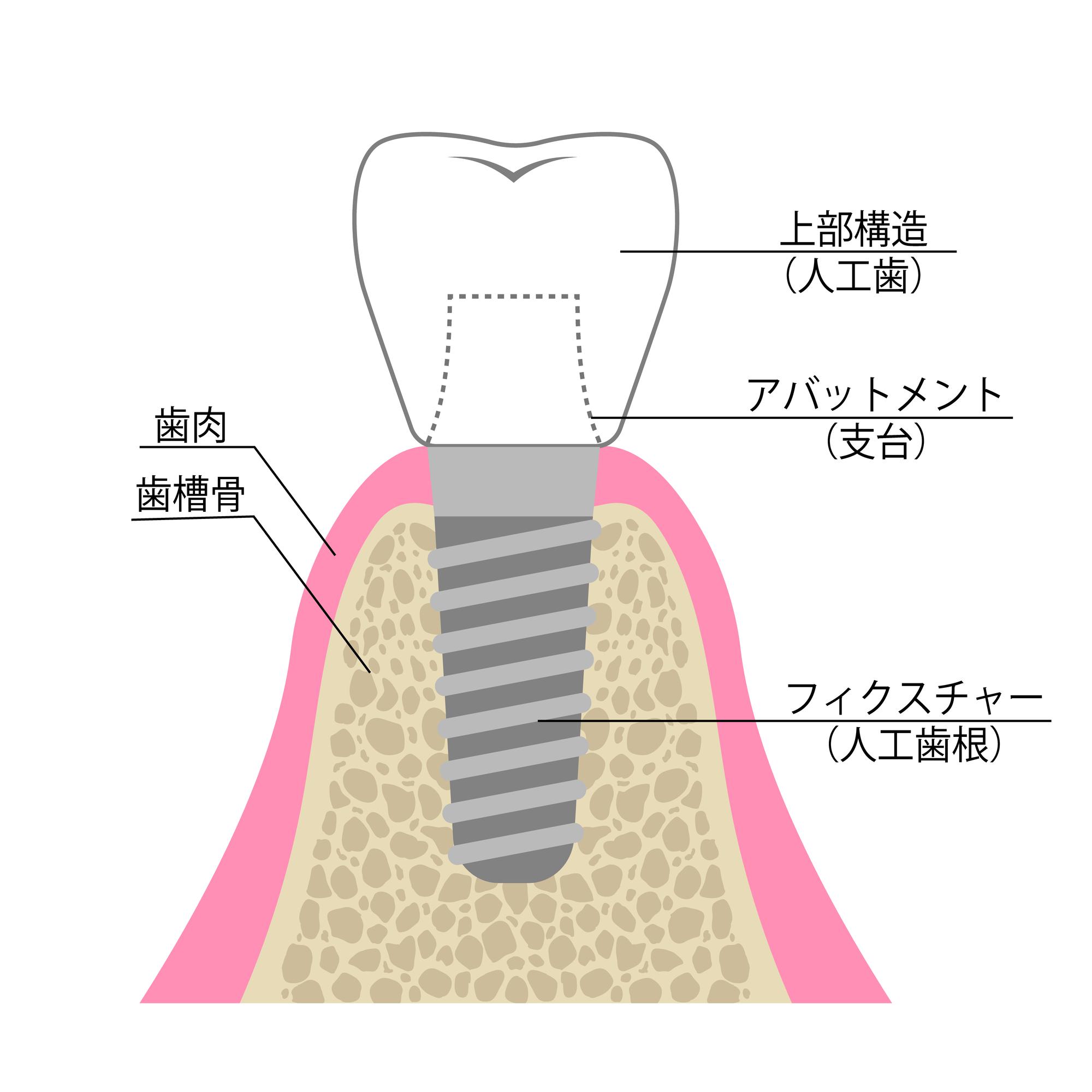 インプラントの図解