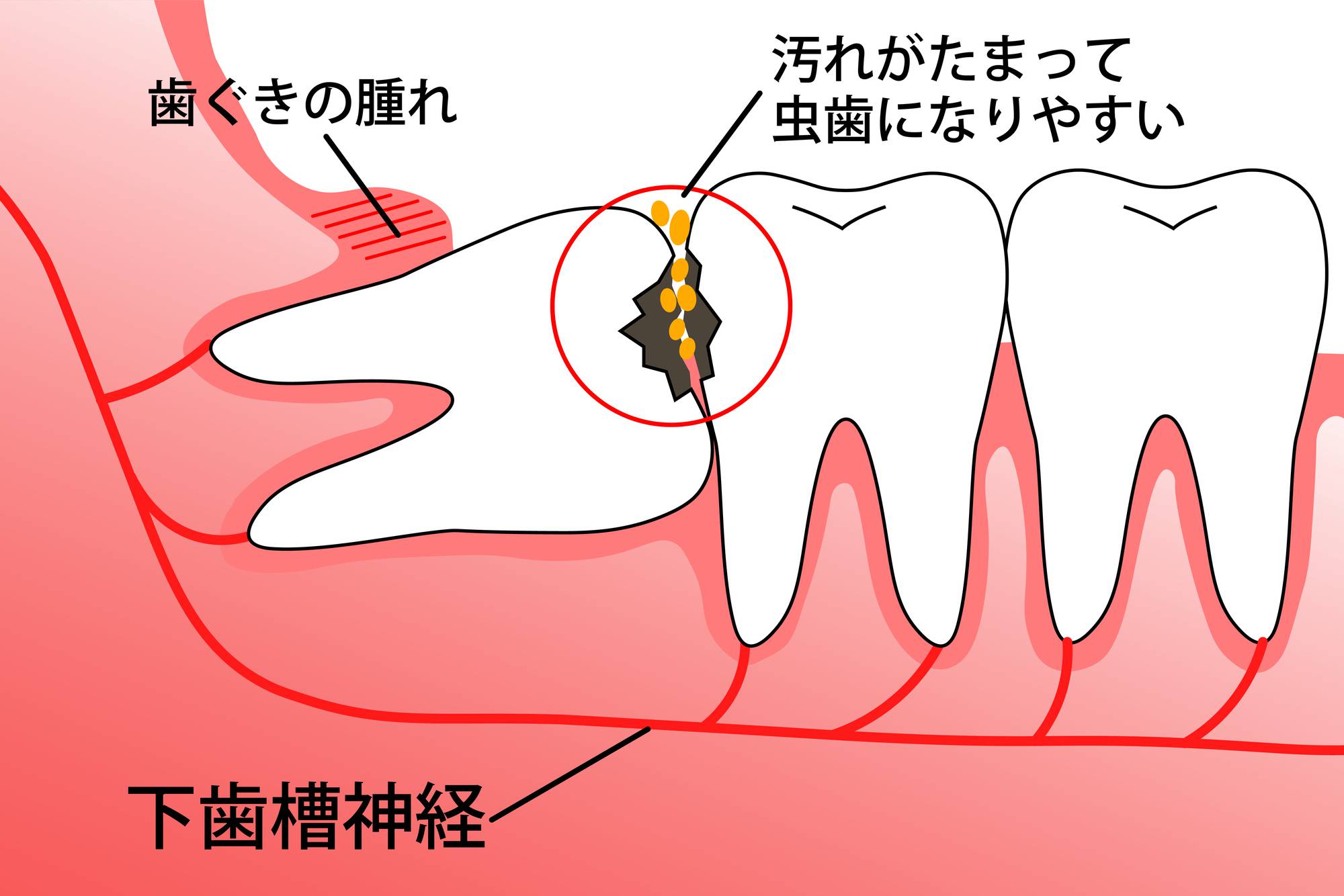 親知らずのイラスト
