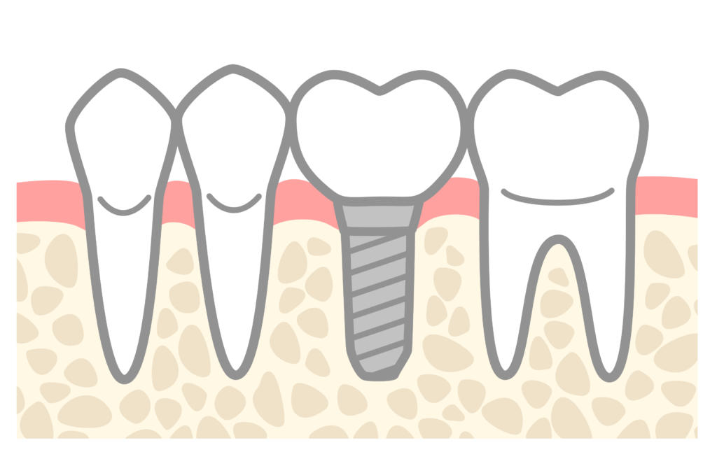 いくらかかるの？インプラント“費用”について解説