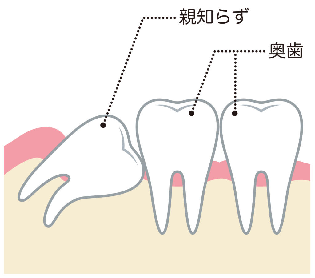 親知らずの痛みの原因4つ！痛い理由は歯茎の炎症や虫歯…その治療法は？