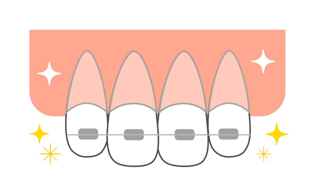矯正中におすすめの歯ブラシを紹介！ 毛束が三角形のブラシとは？